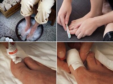 Naparovanie nôh a nanášanie močovinového krému na nechty postihnuté plesňami