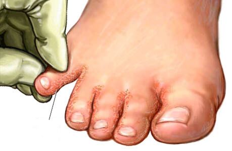 huba medzi prstami na nohách