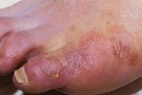 prejavy plesňovej infekcie na koži nôh