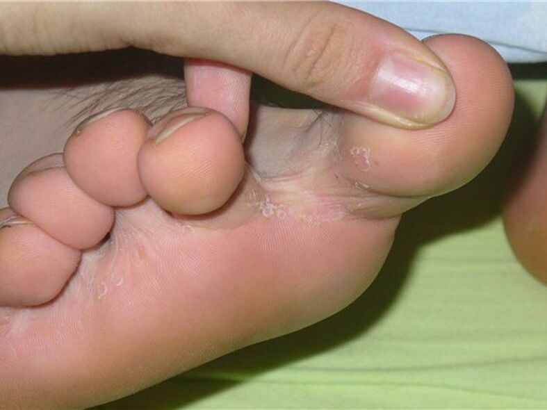 huba medzi prstami na nohách fotka 1