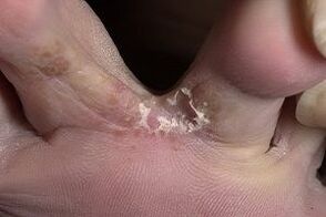 kožná huba medzi prstami na nohách